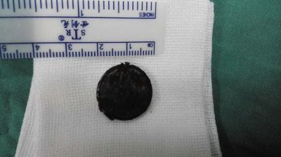 15个月大宝宝误吞纽扣电池 电池被吞后仍在放电